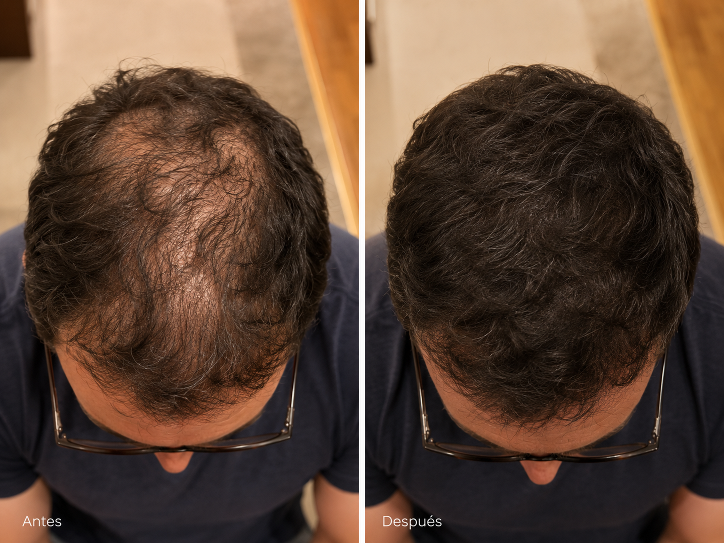Comparativa cosmética antes y después de la rutina Folinove tras un uso continuado