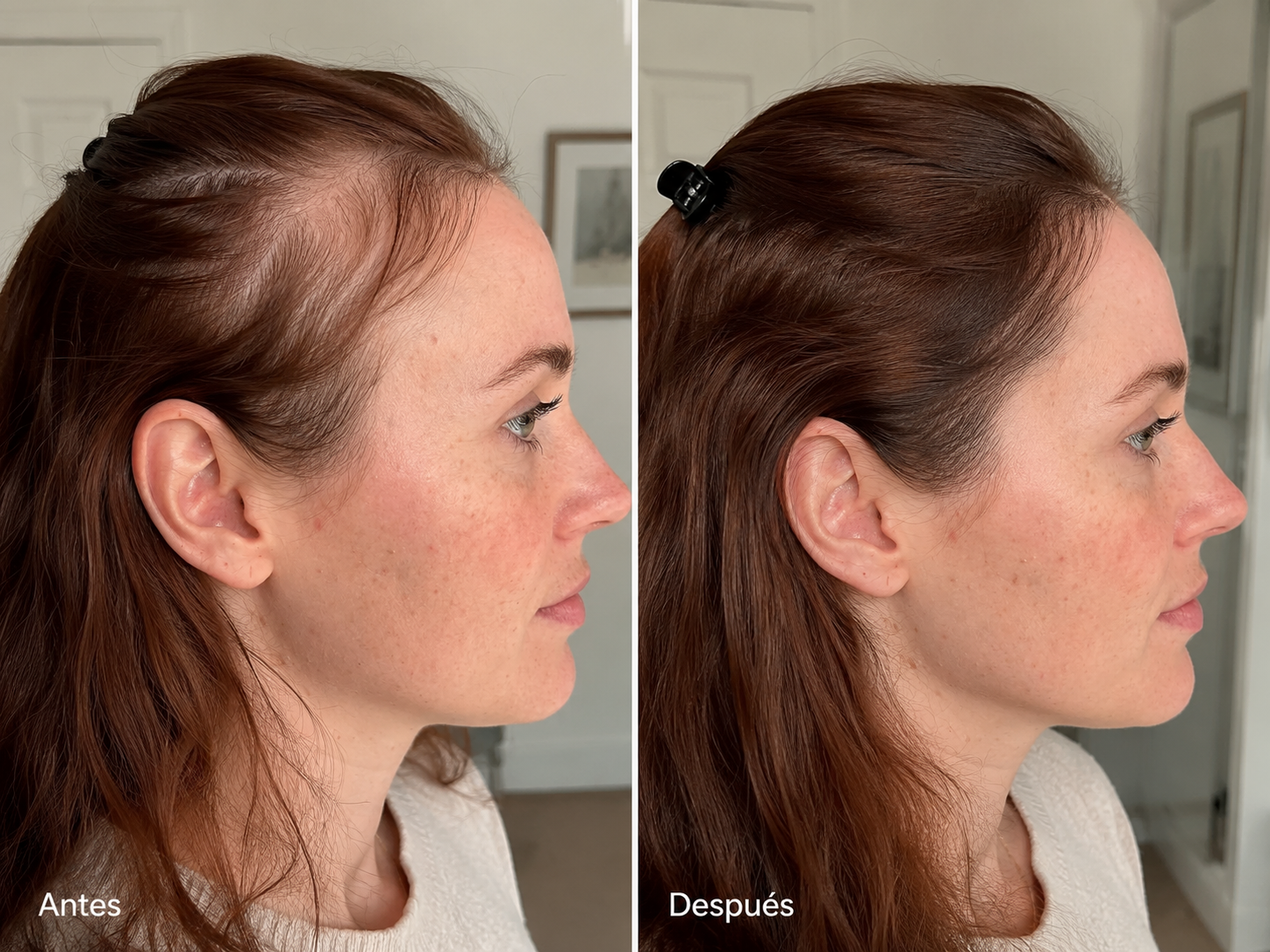 Comparativa cosmética antes y después de la rutina Folinove tras un uso continuado